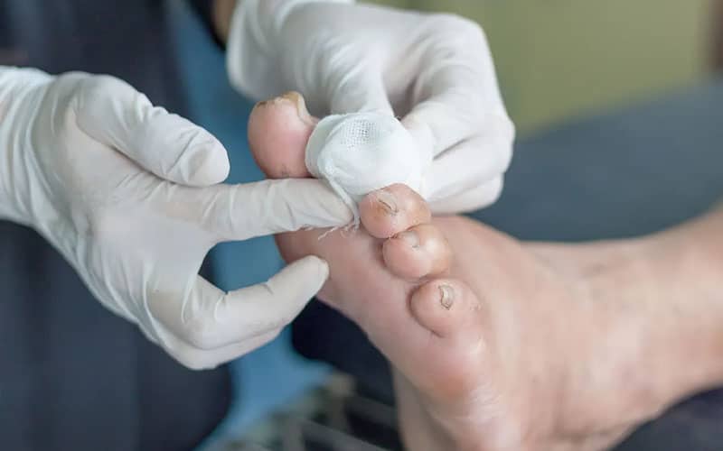 آموزش پانسمان زخم دیابت