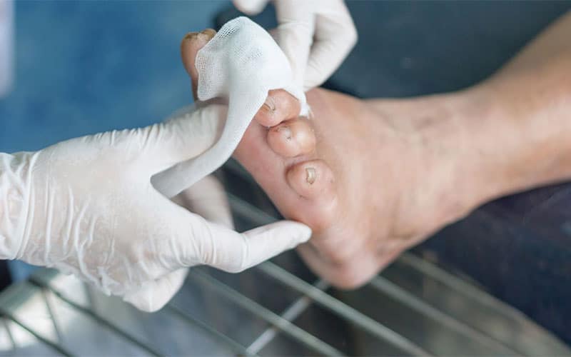 آموزش پانسمان زخم دیابت