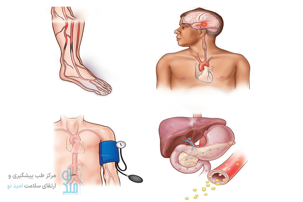 مشکلات ناشی از چربی خون بالا