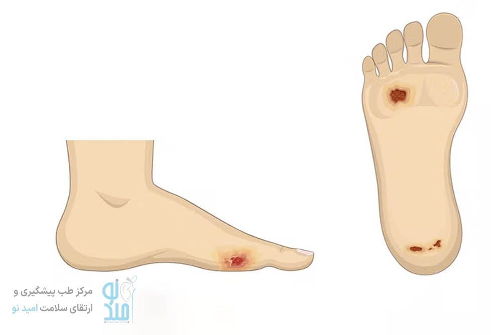 درمان قطعی زخم پای دیابت