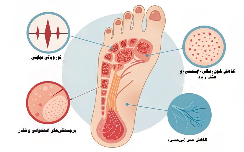 انواع زخم پای دیابتی