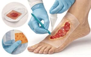 چگونگی بهبود زخم دیابتی