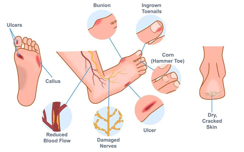 چارچوب کلی برای پیشگیری از زخم های دیابت