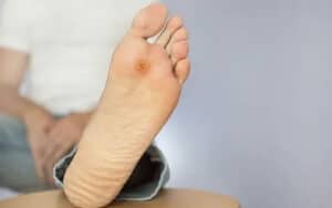 معجزه 1404، درمان قطعی زخم دیابت