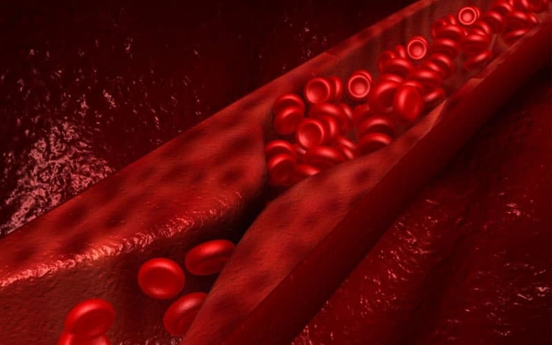 آسیب به (ماکروواسکولار): نرسیدن امداد