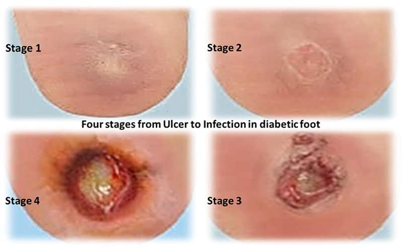 علت دیر خوب شدن زخم دیابتی