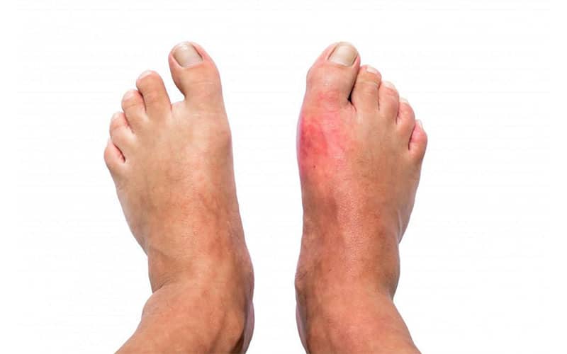 نوروپاتی محیطی