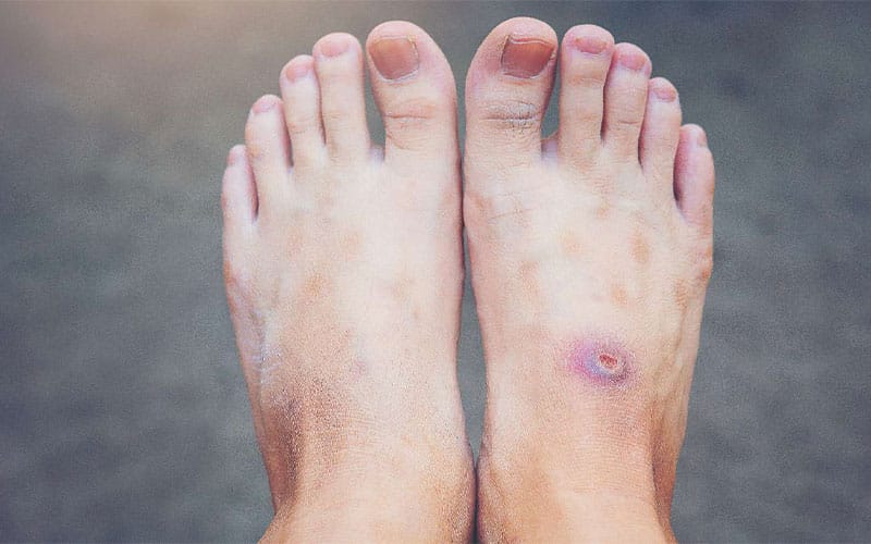 چرا زخم در افراد دیابتی دیرتر خوب می شود؟