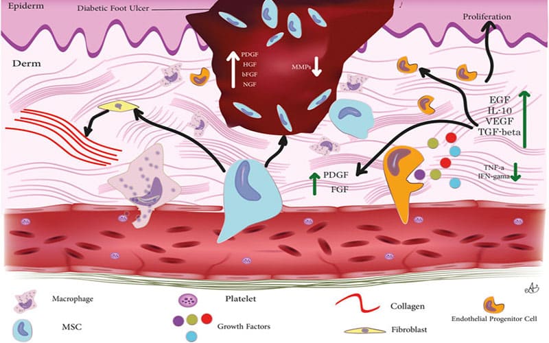 فرآیند درمان زخم دیابتی با سلول های بنیادی